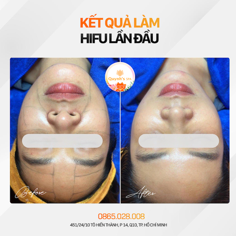 Hình ảnh khách hàng trước và sau khi làm HIFU lần đầu tại Quỳnh Spa quận 10