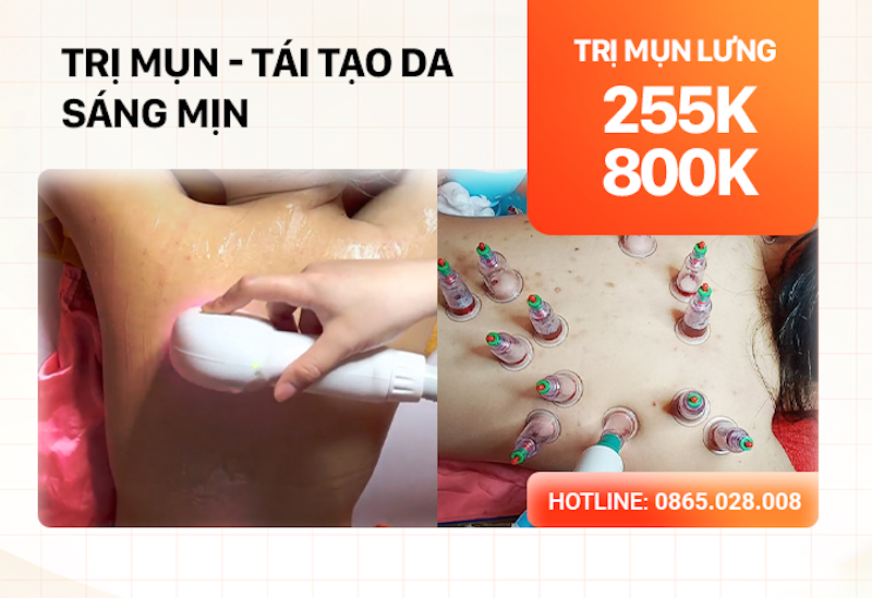 Trị mụn lưng