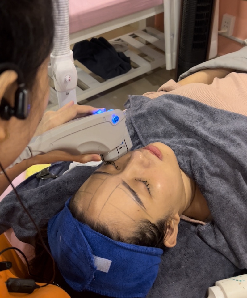 Hifu điều trị nếp nhăn cau mày quận 10 - Quynh's Spa Hifu điều trị nếp nhăn cau mày quận 10 - Quynh's Spa