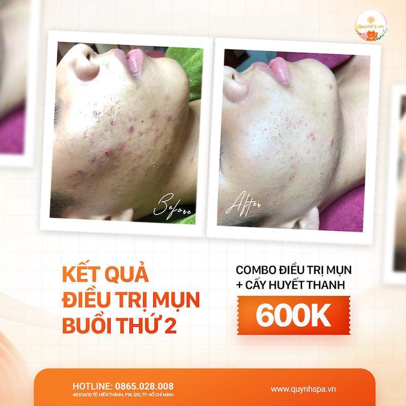 Hiệu quả điều trị mụn cấy huyết thanh - Quynh's Spa quận 10