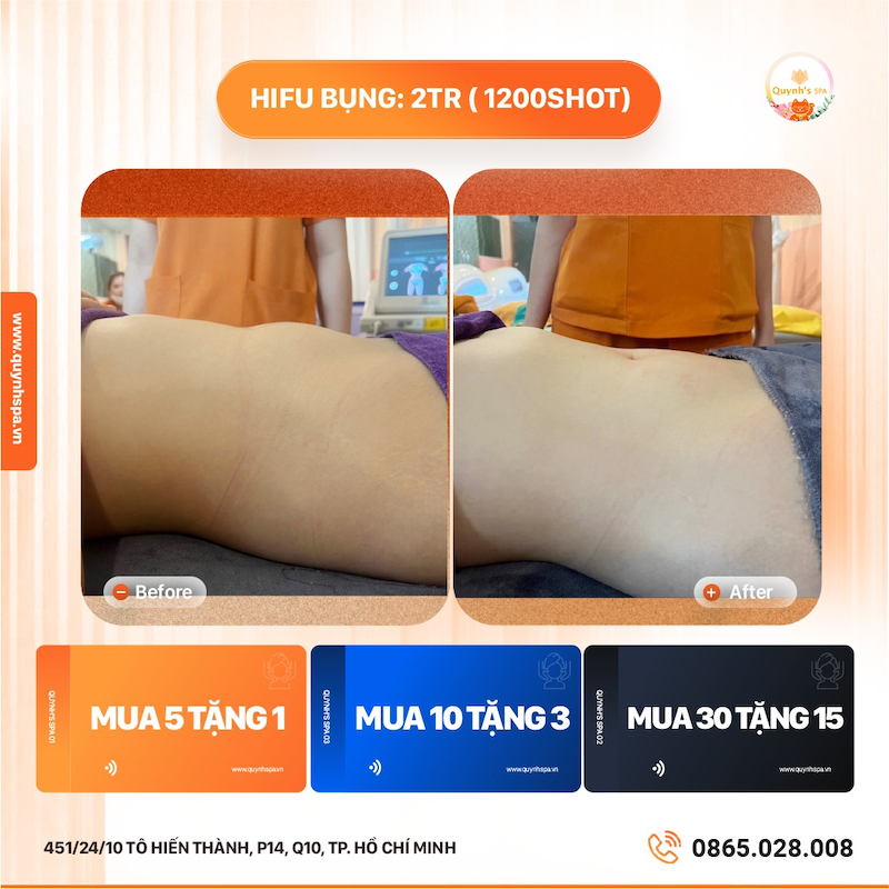 Hifu liệu trình thon gọn bụng - Quynh's Spa quận 10