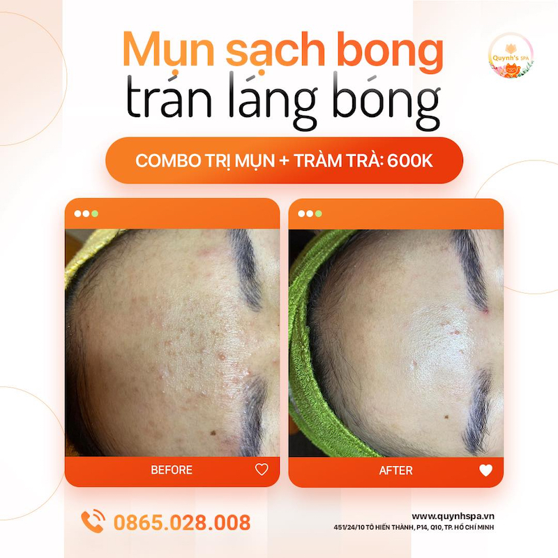 Ngày ấy ngày ấy sẽ không xa đâu, ngày mà mụn sạch bong trán láng bóng Ngày ấy ngày ấy sẽ không xa đâu, ngày mà mụn sạch bong trán láng bóng