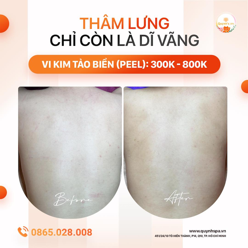 Thâm lưng chỉ còn là dĩ vãng - Quynh's Spa quận 10
