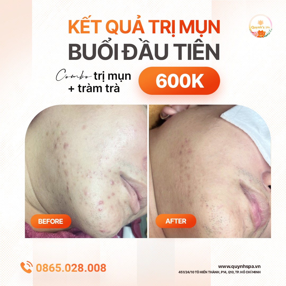 Kết quả trị mụn tràm trà buổi đầu tiên - Quynh' spa quận 10