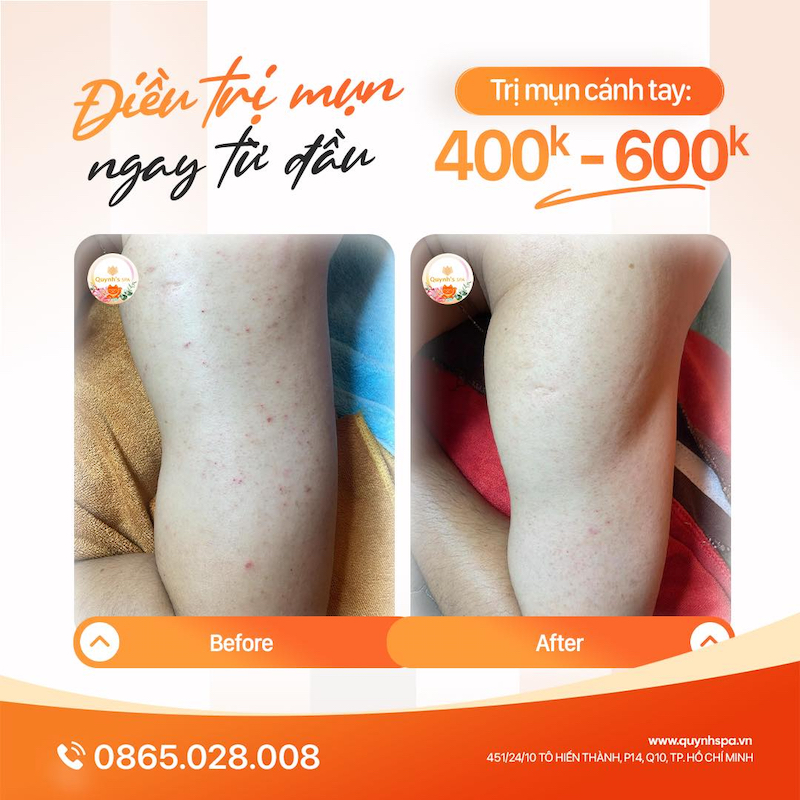 Điều trị mụn cánh tay ngay từ đầu - Quynh' Spa quận 10
