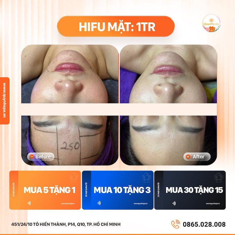 Hifu trẻ hóa nâng cơ Quynh's Spa quận 10 HCM