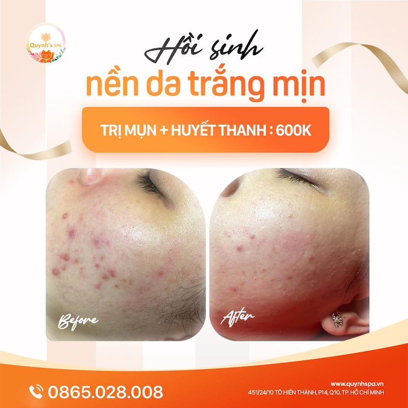 Hồi sinh làn da trắng mịn - Quynh's Spa quận 10