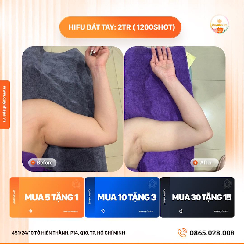 Lời giải nhanh gọn hiệu quả hút mỡ bắp tay Quỳnh's Spa Q.10