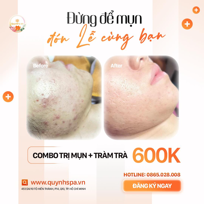 Đừng để mụn đón Lễ cùng bạn - Quynh's Spa uy tín