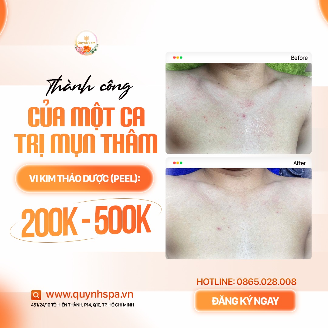 Đổi mới làn da - Mụn thâm bay xa cùng Quynh's Spa TP.HCM Đổi mới làn da - Mụn thâm bay xa cùng Quynh's Spa TP.HCM