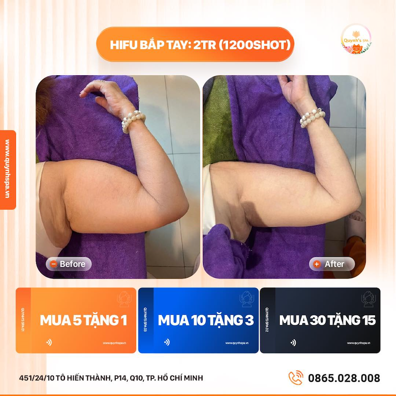 Mỡ có thể ăn kiêng để giảm nhưng mà… lâu lắm - Quynh's Spa HCM