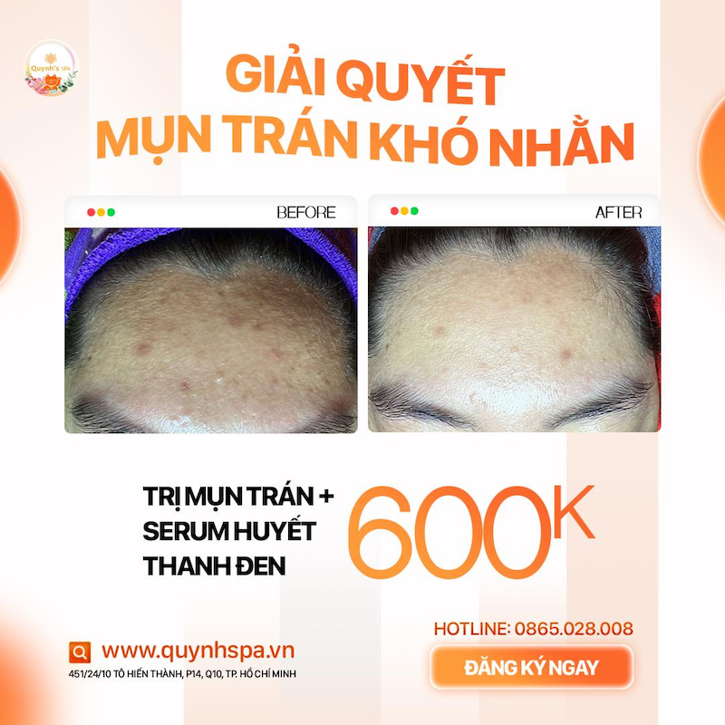 Mụn trán khó nhằn - Trị sớm khỏi lăn tăn cùng Quynh's Spa TP.HCM