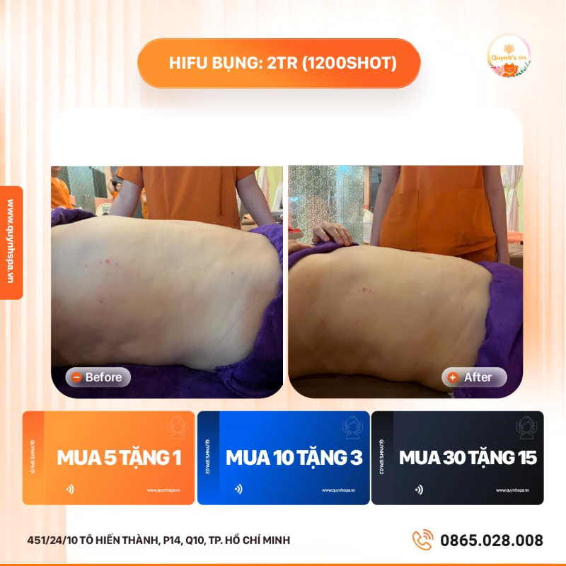 Cập nhật tình hình giảm mỡ cuối năm tại Quỳnh Spa Quận 10