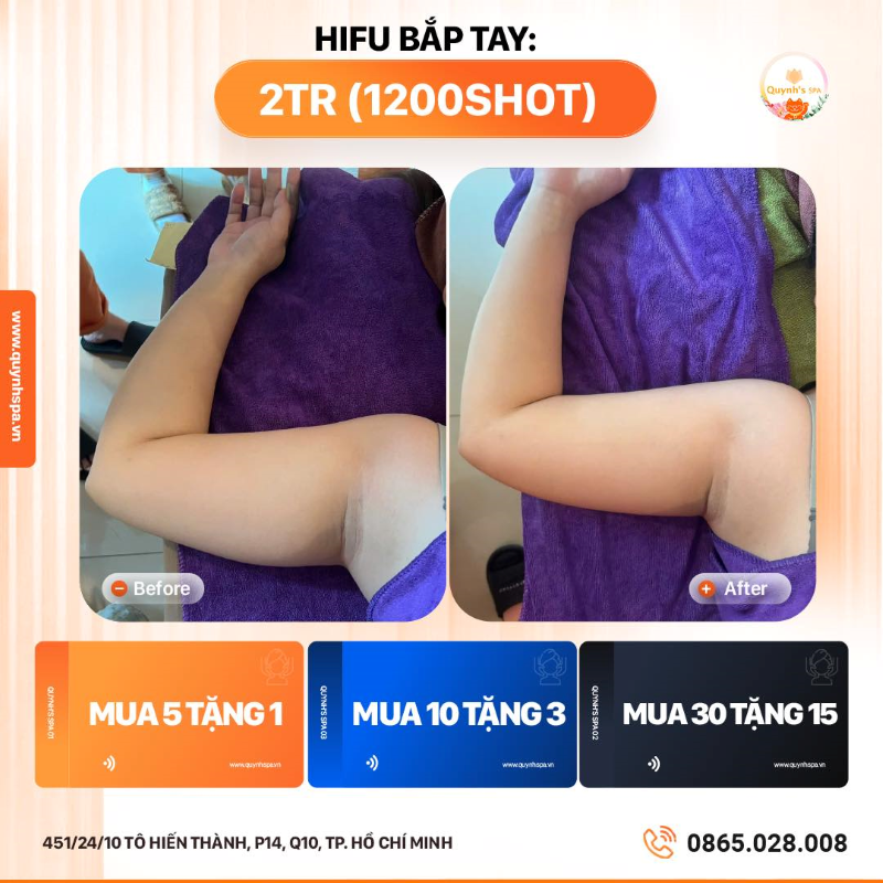 Chạy nước rút giảm mỡ cùng Hifu Body - Quynh's Spa TP.HCM