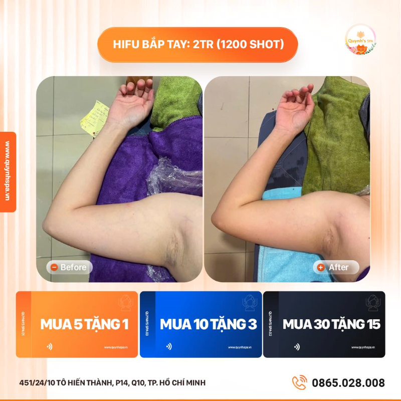 Có một sự quyết tâm không hề nhẹ - hifu Body tại Quynh's Spa HCM