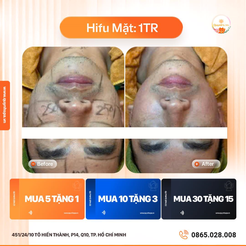 Dịch vụ Hifu Mặt luôn chiếm trọn cảm tình của khách Quynh's Spa Quận 10