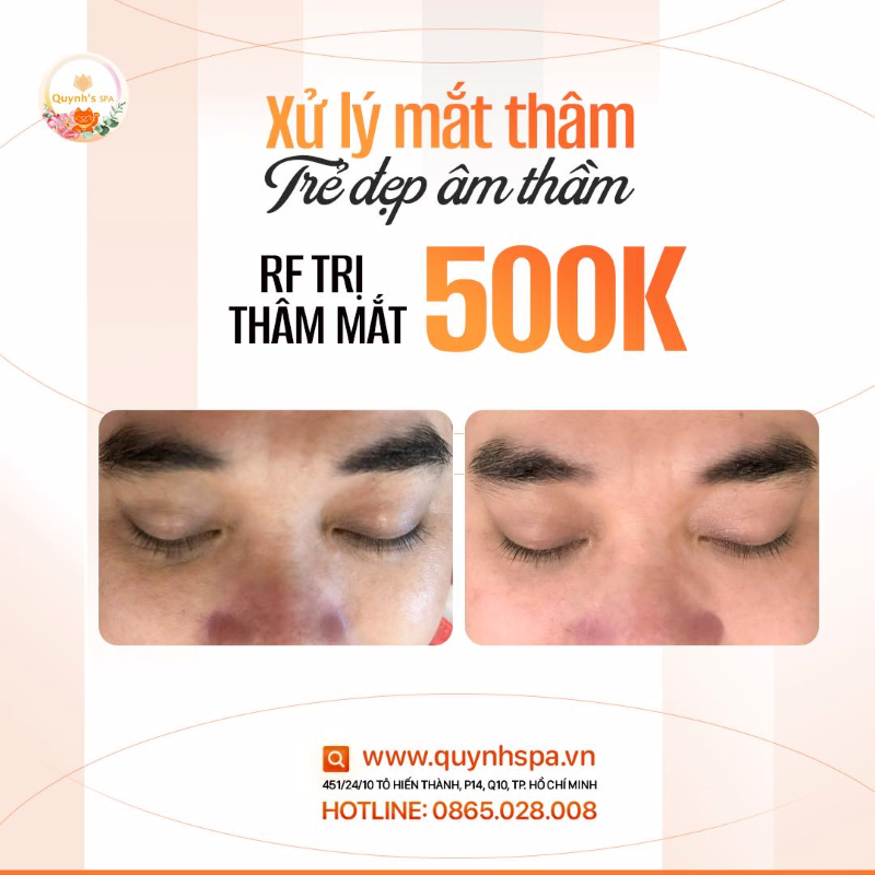 Không hiểu sao mắt anh cứ thâm hoài không hết - Quynh's Spa