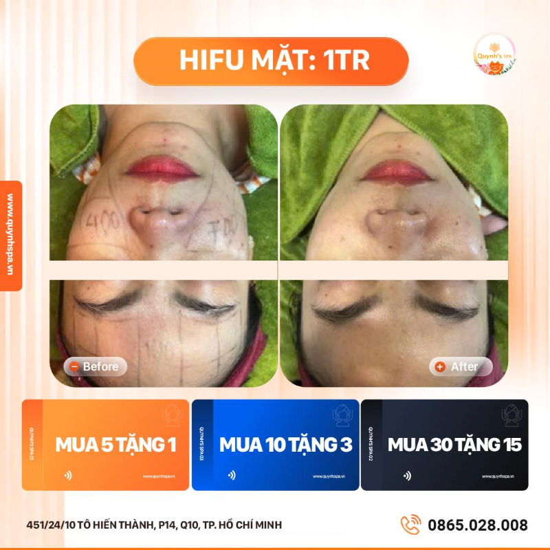 Trộm vía Hifu được khách hàng yêu thương quá nhiều cùng Hifu Quynh's Spa Q10