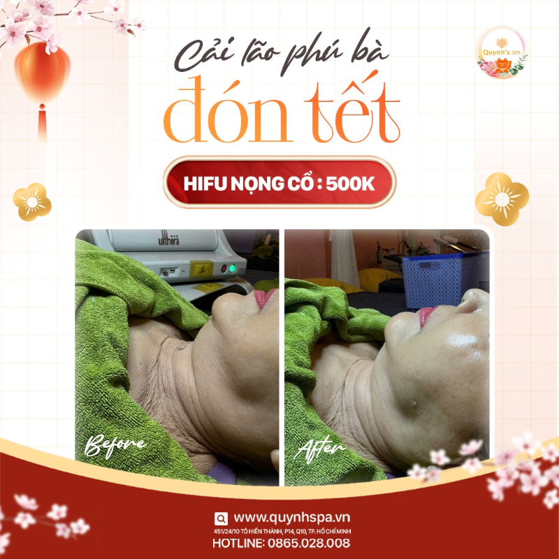 Cải lão phú bà đón Tết 2025 cùng Hifu mặt Quynh' Spa TP.HCM