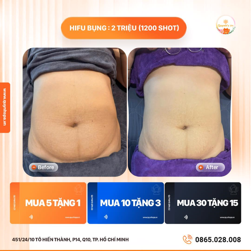 Giải phóng mỡ - Chào năm mới rực rỡ cùng Hifu Bụng tại Quynh's Spa Q.10