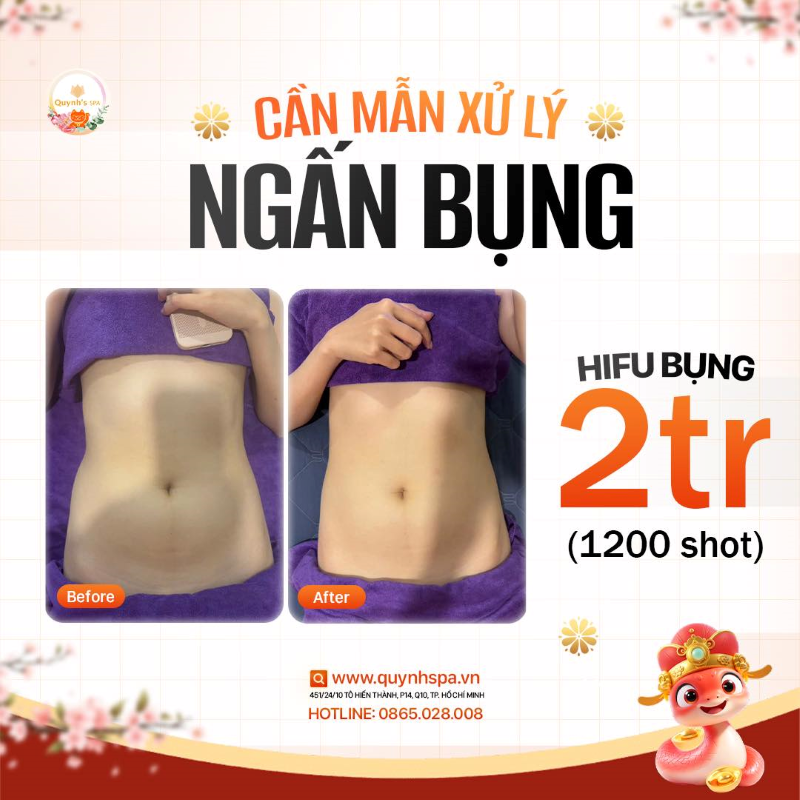 Lại thêm một ngày cần mẫn xử lý “ngấn bụng” cùng Hifu Body - Quynh's Spa Quận 10