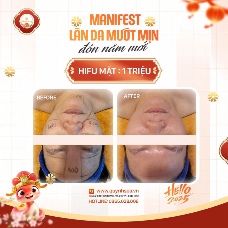 Manifest làn da căng bóng đón năm mới cùng Hifu mặt - Quynh's Spa TP.HCM