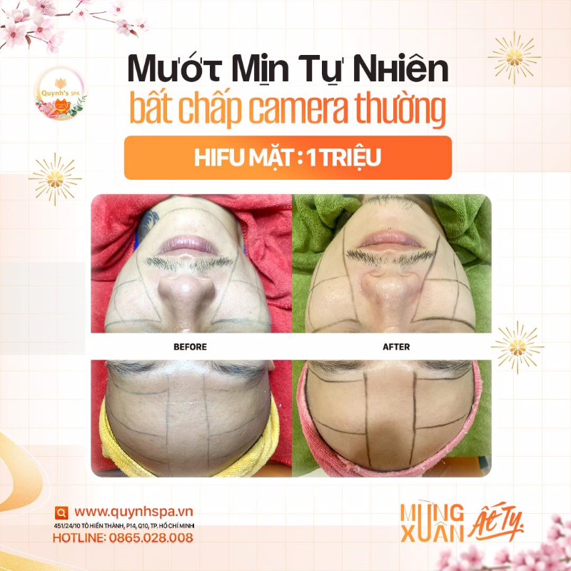 Mướt mịn tự nhiên bất chấp camera thường cùng Hifu V Line Quynh's Spa TP.HCM