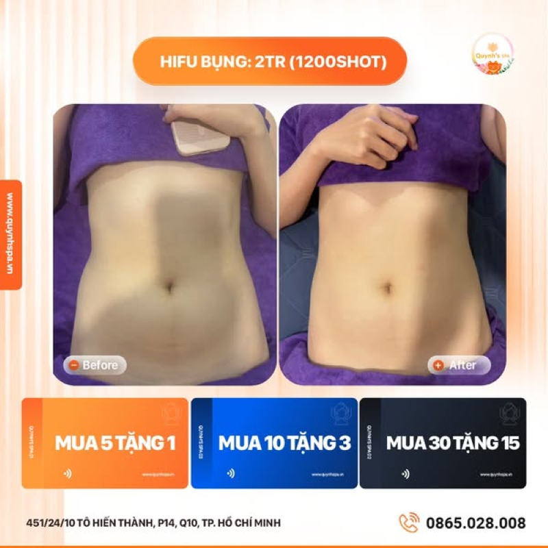 Xua tan mỡ bụng, đón tết nhẹ nhàng cùng Hifu bụng Quynh's Spa Q10