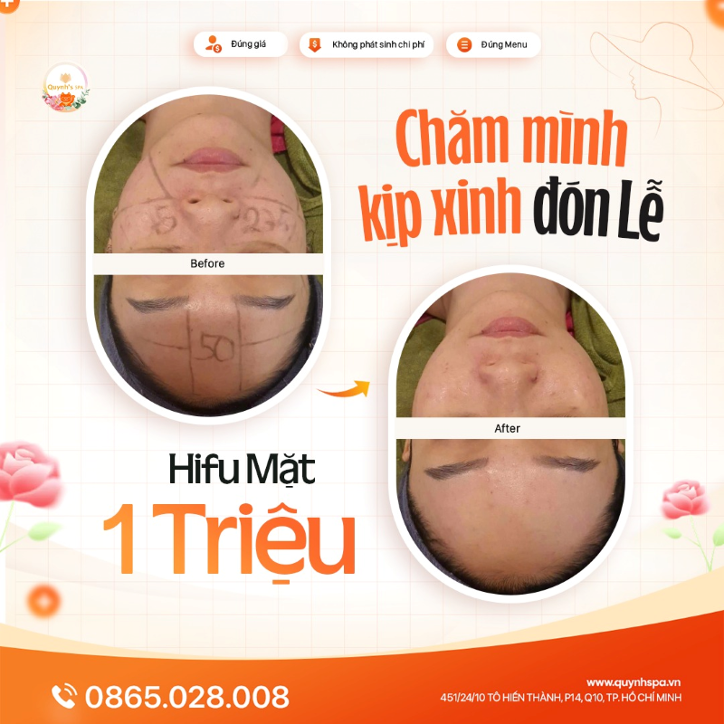 Chăm mình kịp xinh đón 8/3 cùng Hifu V Line - Quynh's Spa TP.HCM