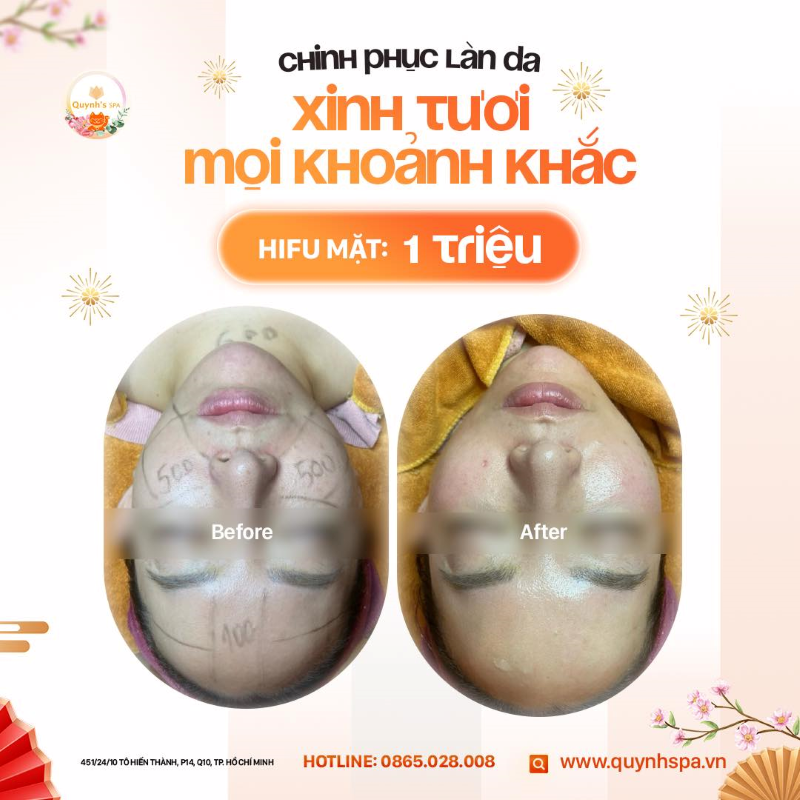 Chinh phục làn da - Xinh tươi mọi khoảnh khắc cùng Hifu Mặt tại Quynh's Spa Q10