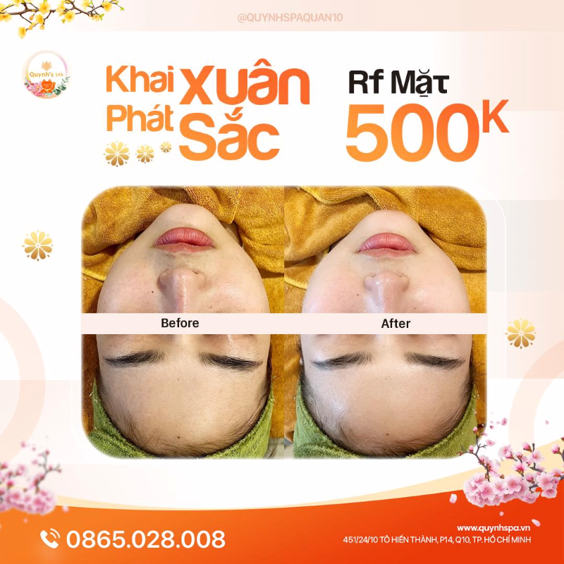 Khai Xuân Phát Sắc cùng liệu trình RF Mặt tại Quynh's Spa TP.HCM