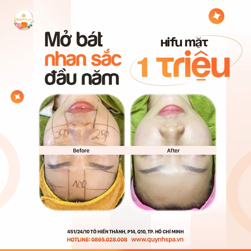 Mở bát nhan sắc đầu năm cùng Hifu Mặt tại Quynh's Spa quận 10