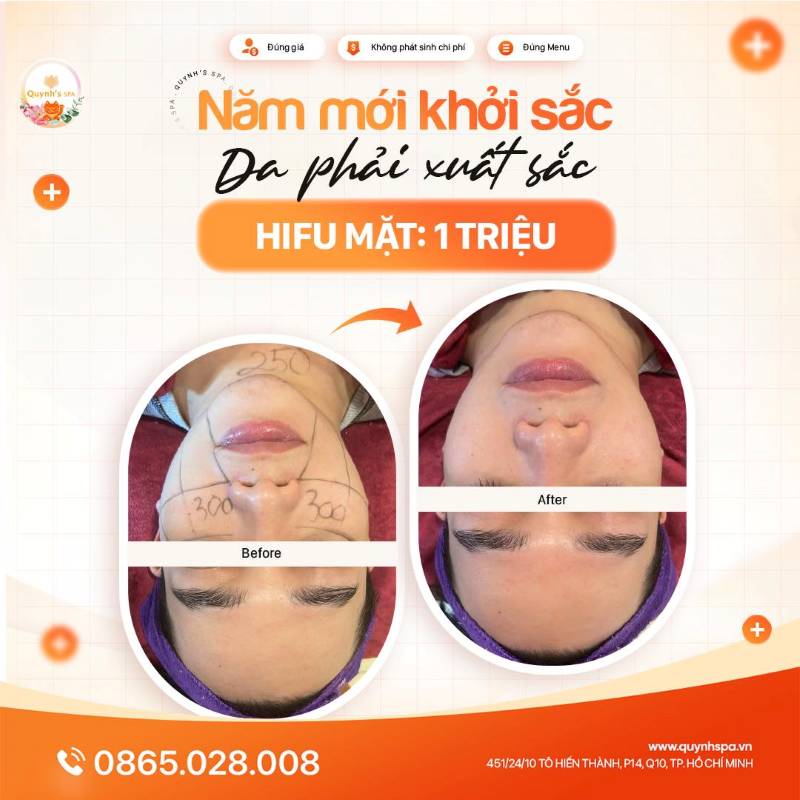 Năm mới khởi sắc, làn da phải xuất sắc cùng Hifu Quynh's Spa Q.10