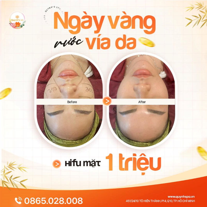 Ngày Vàng - Rước Vía Da cùng Hifu mặt tại Quynh's Spa TP.HCM