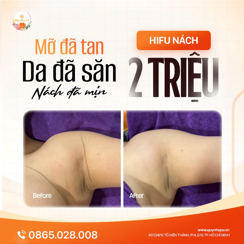 Giảm mỡ nách không lo tổn thương cùng Hifu tại Quynh's Spa quận 10
