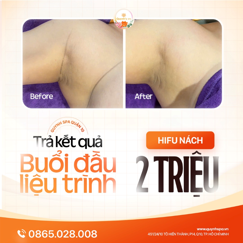 Trả kết quả buổi đầu Hifu Nách tại Quynh's Spa Quận 10