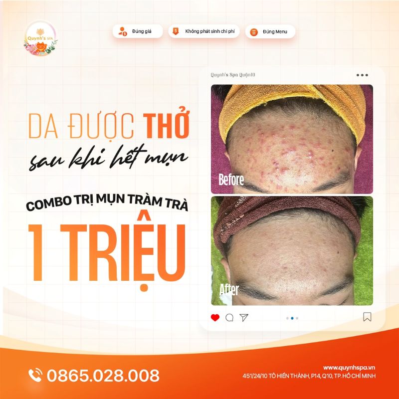 Cảm giác da được “thở” sau khi hết mụn sẽ thế nào tại Quynh's Spa Q.10
