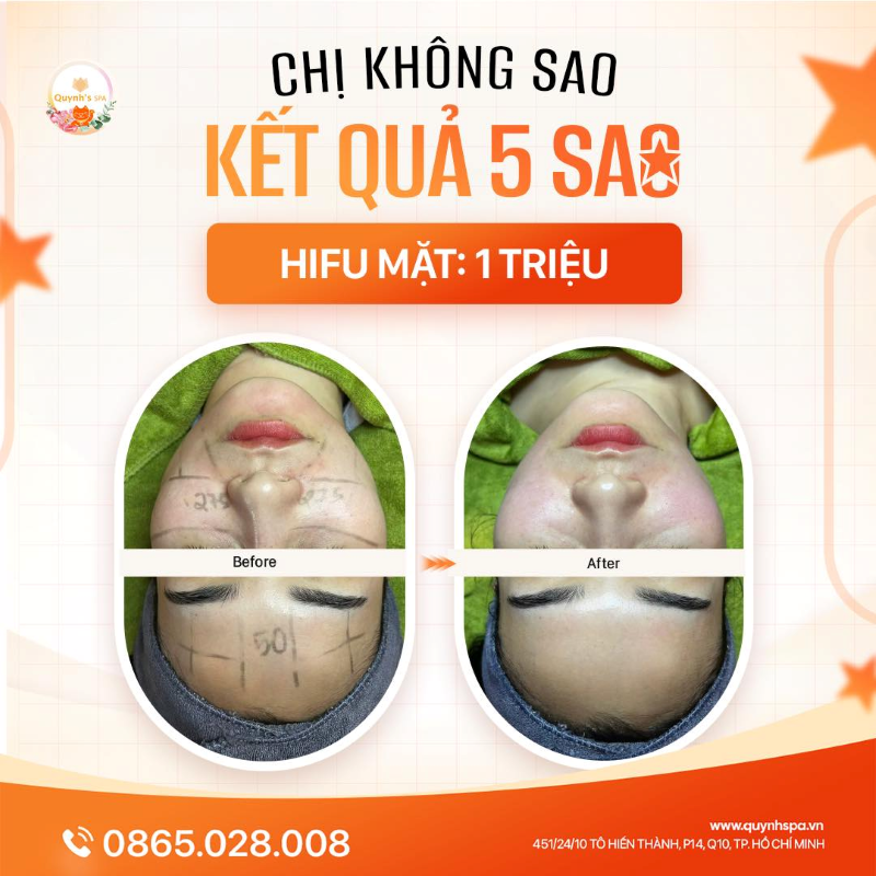 Chị không sao, kết quả 5 sao cùng Hifu Mặt Quynh's Spa TP.HCM
