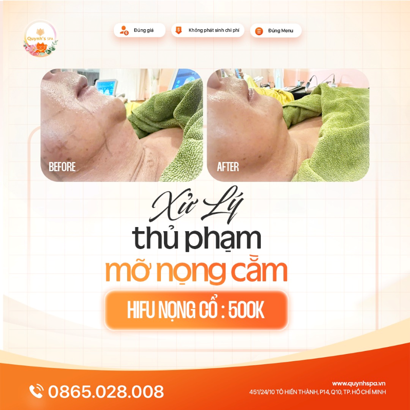 “Mỡ chùng nhão” hay “thon gọn căng mịn” cùng Hifu Nọng cổ tại Quynh's Spa quận 10