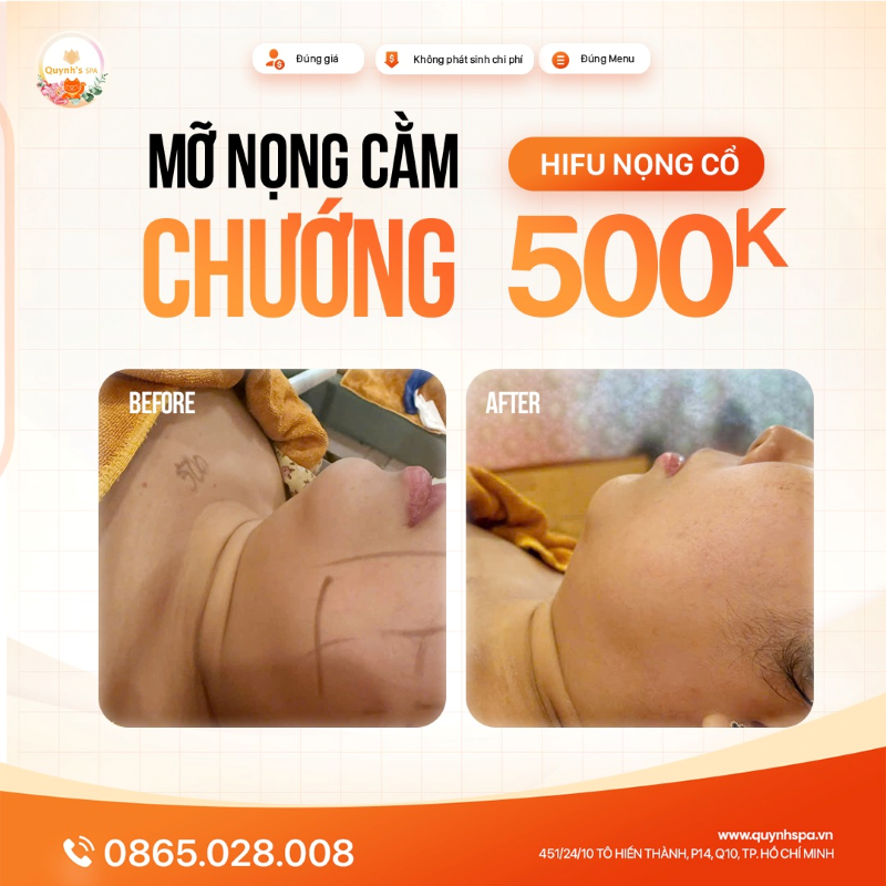 Mỡ nọng này chướng Hifu nọng cổ tại Quynh's Spa Q.10