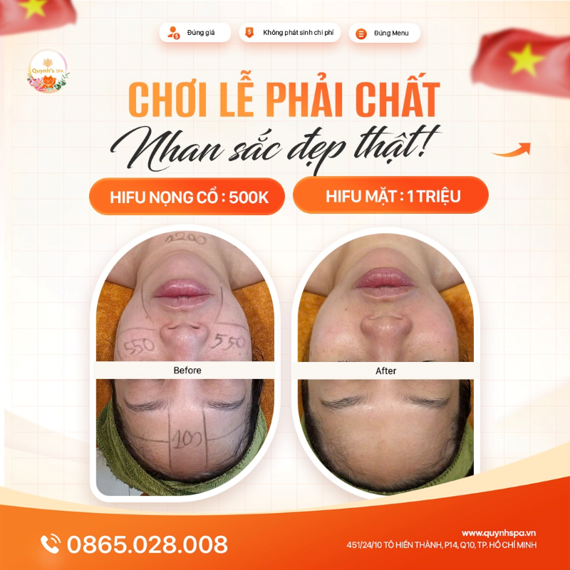 Chơi Lễ Phải Chất – Nhan Sắc Đẹp Thật cùng Hifu Vline Quynh's Spa Q10
