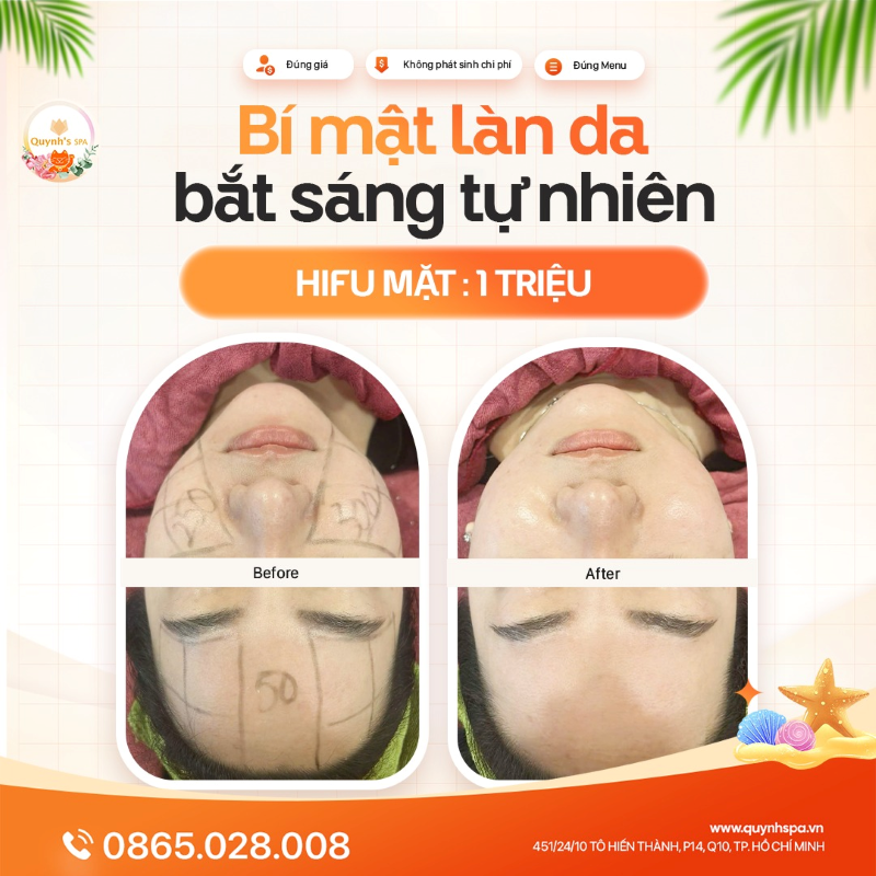 Da bắt sáng không phải tự nhiên mà có - Nhà Quỳnh có bí kíp - Hifu Mặt Quynh's Spa 