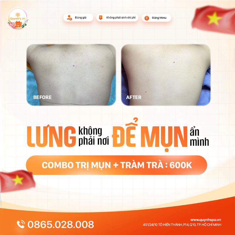 Lưng không phải nơi để mụn ẩn mình, mà là nơi để làn da nàng toả sáng