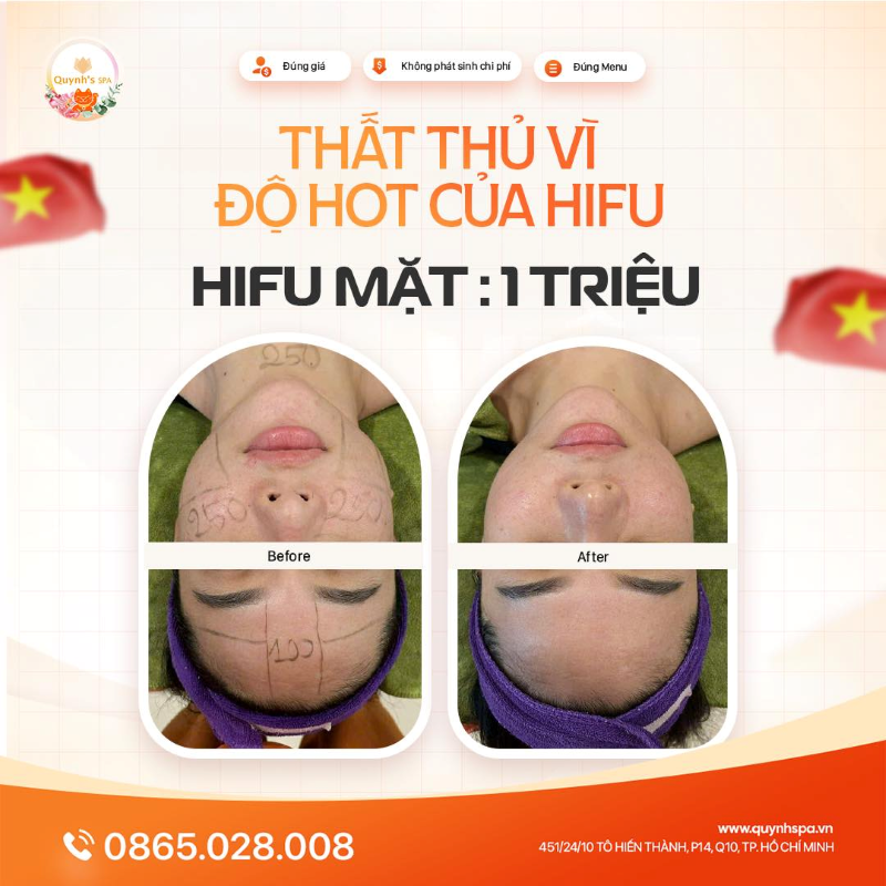 Thất thủ ngày lễ cùng Hifu Mặt tại Quynh's Spa TP.HCM
