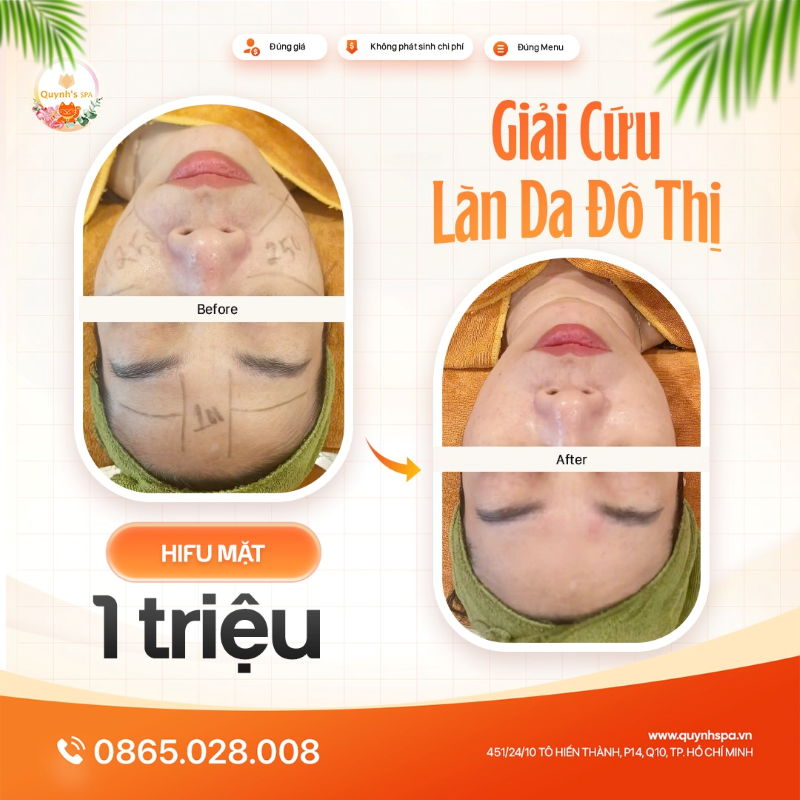 Giải cứu làn da đô thị cùng Hifu nâng cơ trẻ hóa tại Quynh's Spa Q.10