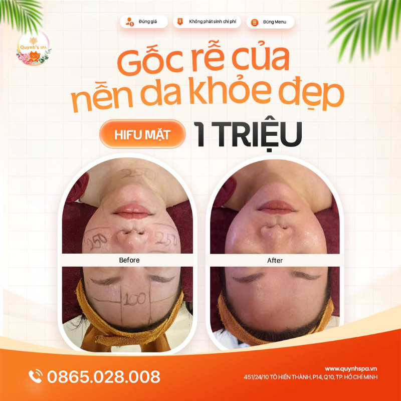 Gốc rễ của nền da khỏe đẹp cùng Hifu Mặt - Quynh's Spa Q10