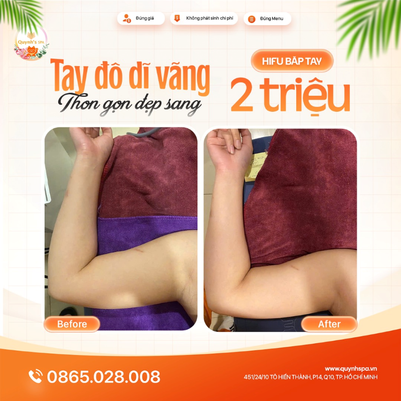Hết thời “tay đô” - Chạm tới phiên bản thon gọn cùng hifu bắp tay tại Quynh's Spa Q.10