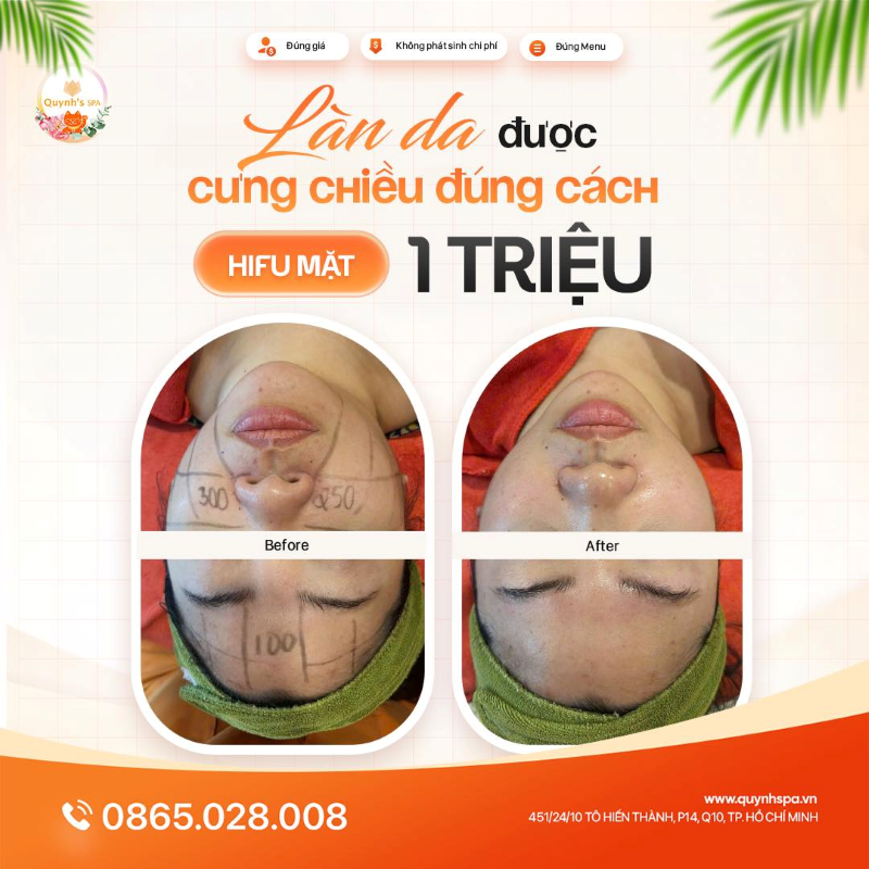 Khi làn da được cưng chiều đúng cách cùng Hifu mặt - Quynh's spa Q.10