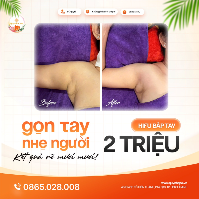 Từ ngày giảm mỡ bắp tay chị thấy nhẹ người hẳn với Hifu bắp tay Quynh's Spa quận 10