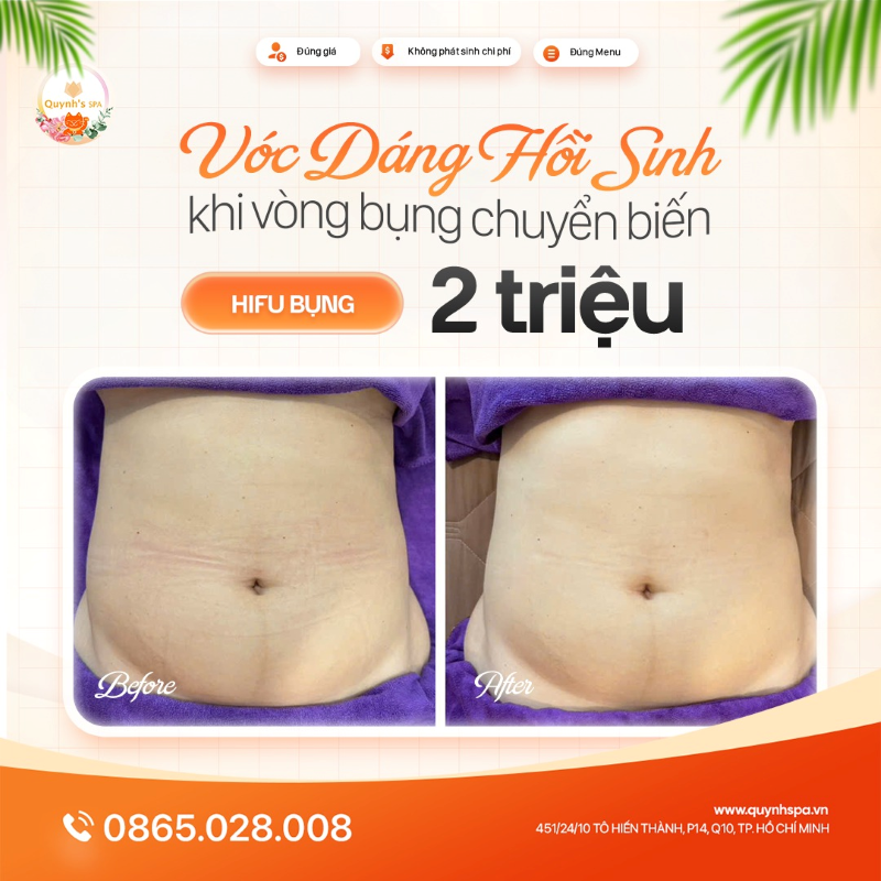 Vóc dáng hồi sinh khi vòng bụng chuyển biến với Hifu bụng Quynh's Spa Q.10